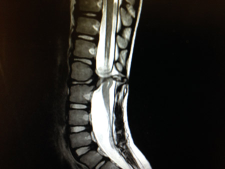 This x-ray shows the split in N.B.'s spinal cords that Dr. Azedine Medhkour repaired.